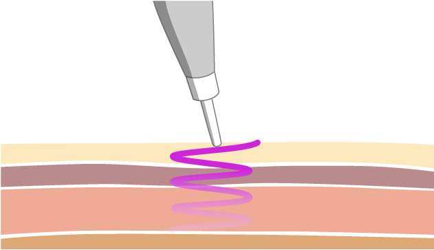 mechanism step1