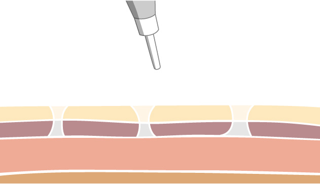 mechanism step2