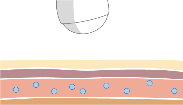 mechanism step4