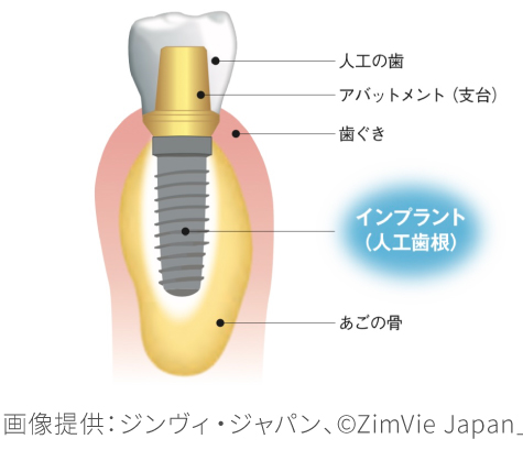 インプラント2